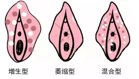 外阴白斑有哪些类型?