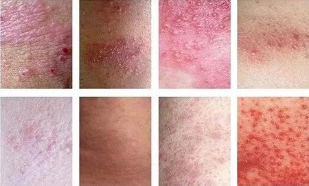 怎么区分外阴白斑和外阴湿疹?