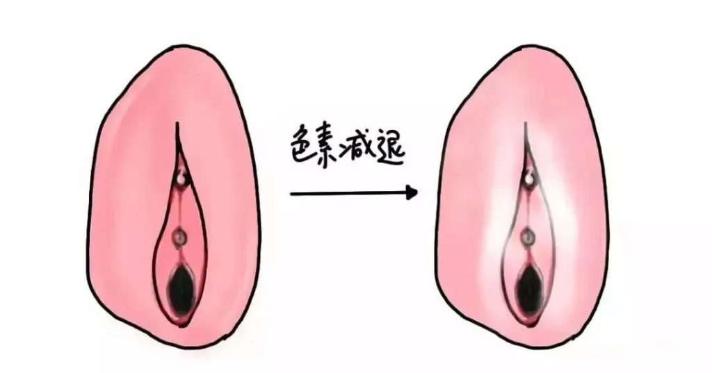 女孩子外阴部位出现外阴营养不良是怎么回事?