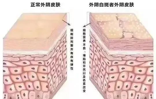 外阴白斑疾病为什么那么难治疗