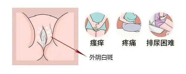 混合型外阴白斑的病因和危害都有哪些?