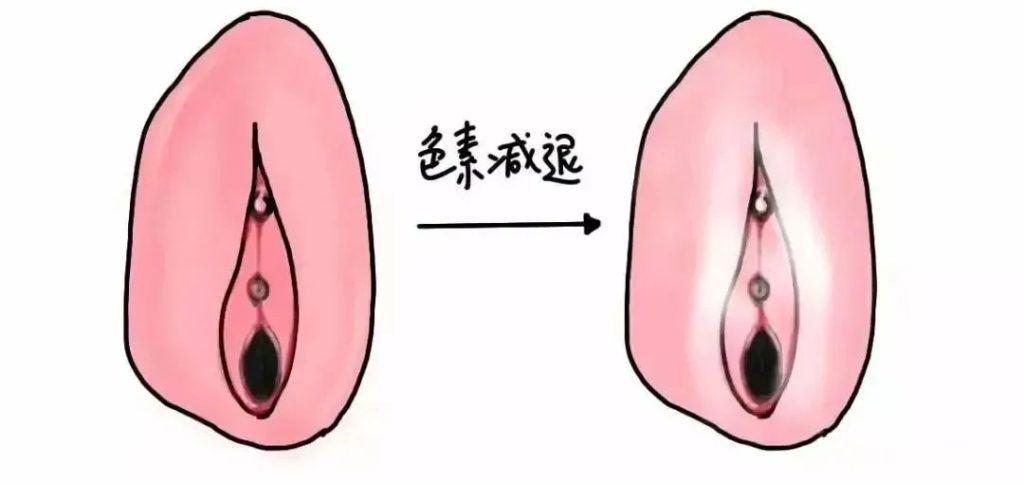 怎样判断自己得了外阴白斑
