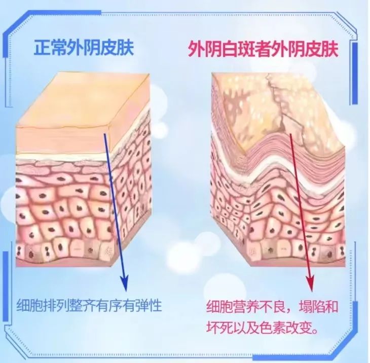 得了外阴白斑后为什么要做专项检查?