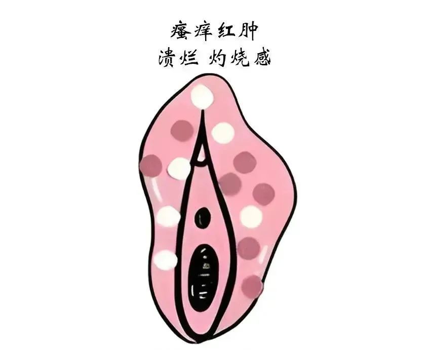 各个类型的外阴白斑具体分期和主要症状有哪些?